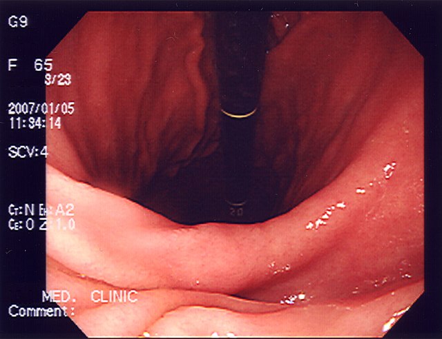 Endoskopické vyšetření žaludku