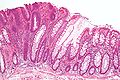 Lésions précancéreuses - Adénome tubulaire (à gauche de l'image), un type de polype du côlon et un précurseur du cancer colorectal (la muqueuse colorectale normale est visible à droite).
