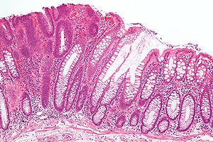 Tubular adenoma 2 intermed mag.jpg