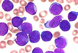 Cellules de leucémie.