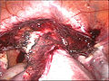 laparoskopická hysterektomie