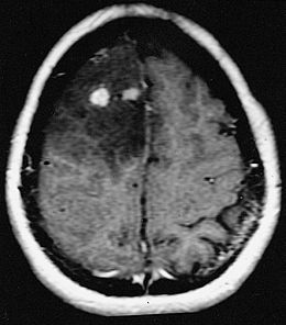 Description de l'image 405518-FIBRILLARY OR DIFFUSE ASTROCYTIC NEOPLASM.jpg.