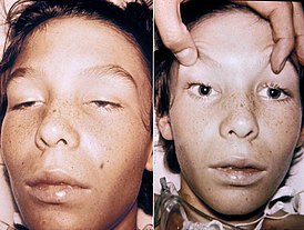 Двусторонняя офтальмоплегия и птоз при ботулизме у 14-летнего ребёнка. Сознание полностью сохранено.
