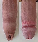 Penis före och efter omskärelse.