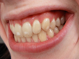 English: Photo of mild dental fluorosis, or ev...
