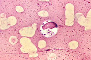 Leishmania donovani in bone marrow cell. Smear...