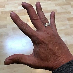 إصبعٌ مطرقية في الإصبع الأوسط، حيثُ ينحني طرف الإصبع لأسفل بينما تظل الأصابع الأخرى مستقيمة.