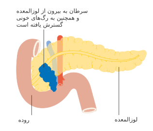 مرحلهٔ T4 سرطان لوزالمعده