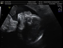 File:Fetus swallowing amniotic fluid feto deglutisce liquido amniotico Dr. Wolfgang Moroder.ogv