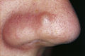 August 27: fibrous papule on the nose