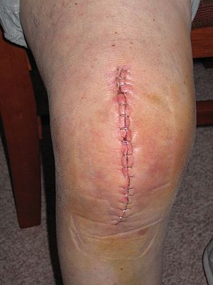 Knee Replacement wound which has been stapled ...