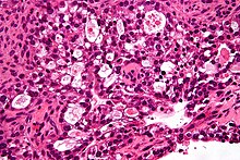 Ovarian clear-cell carcinoma Ovarian clear cell carcinoma - very high mag.jpg