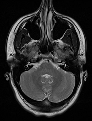 MRI snímek ukazující vrozeně odchýlenou nosní přepážku