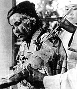Toyoko Kugata, à l'âge de 22 ans, est soignée à l'hôpital de la Croix-Rouge d'Hiroshima, 6 octobre 1945.