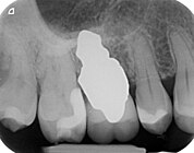 Röntgenaufnahme eines wurzelanalogen dreiwurzeligen Zahnimplantats am rechten ersten oberen Molar