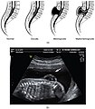 Spina bifida.