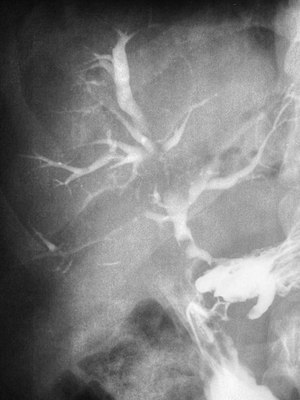 Duodeno Biliary Fistula 08786.jpg