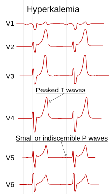 Электрокардиограмма, которая показывает изменения в грудных отводах при гиперкалиемии