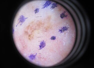 Melanoma in situ, dermatoscope image, right forehead marked for biopsy (Original Post: Shared in Melanoma)