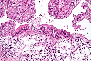 Mucinous lmp ovarian tumour intermed mag.jpg