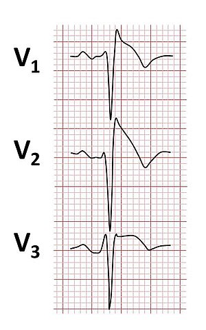 ЕКГ на синдром на Brugada.jpg