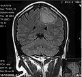 Vignette pour Hémorragie cérébrale