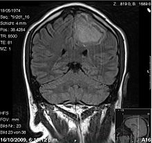 Hemorragie intracerebrale.JPG