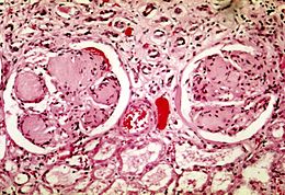 Nodular glomerulosclerosis.jpeg