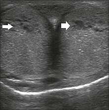 Transverse ultrasound image, ventral view of the penis. Image obtained after induction of an erection, 15 min after injection of prostaglandin E1, showing dilated sinusoids (arrows). Ultrasonography of dilated penile sinusoids during erection.jpg