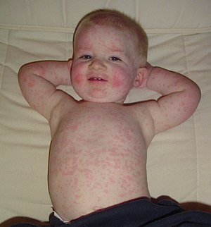 A 16 month old child with Fifth Disease (aka S...