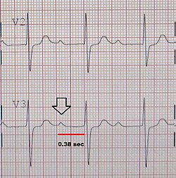 An ECG showing a first degree AV block of greater than 300 ms