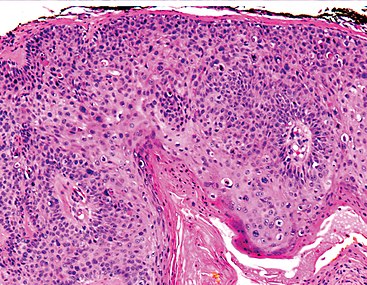 Squamous-cell carcinoma in situ, showing prominent dyskeratosis and aberrant mitoses at all levels of the epidermis, along with marked parakeratosis.[12]