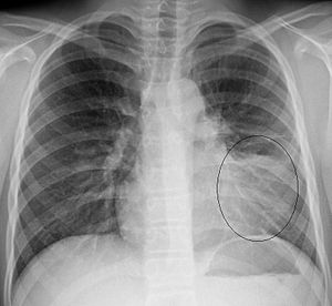 Pneumonia of the lingula of the left lung on CXR.