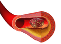 رسم توضيحي يصوّر تكون خثرة فوق لويحة شريانية (arterial plaque).