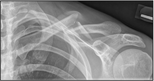 English: Comminuted left clavicle fracture.