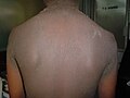 Familial acanthosis nigricans