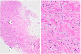 ILC may be subtle on low magnification (left). Higher magnification (right) shows invasive growth pattern and vesicular nuclei with prominent nucleoli.