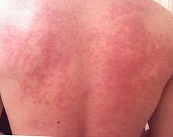 Kopřivka na zádech je častým příznakem alergie.