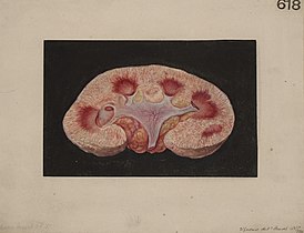 Kidney from a case of chronic parenchymatous nephritis Wellcome L0061750.jpg
