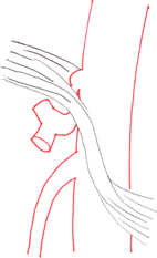 Schematische Darstellung: links der anatomische Normalbefund, das Ligamentum arcuatum medianum liegt oberhalb des Abganges der Arteria coeliaca; rechts gut zu erkennen, wie das Ligamentum das Gefäß einschnürt.