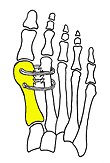 Cerclage bone sutures