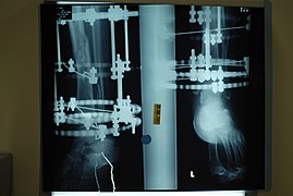 X-ray perspectives of the callus-formation progress and healing of the fractured tibia and fibula bones, four months post-fracture.