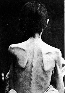 The back of a person with anorexia Louis Bataille, 'Deux cas d'anorexie hysterique' Wellcome L0020548 (backcropped).jpg