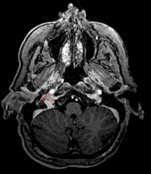 English: Glomus Jugulare Tumor