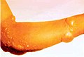 Lecur kimia pada lengan yang disebabkan oleh agen lepuh seperti gas mustard.