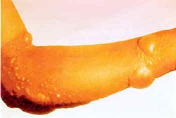 http://upload.wikimedia.org/wikipedia/commons/thumb/b/bd/Blister-arm.jpg/250px-Blister-arm.jpg