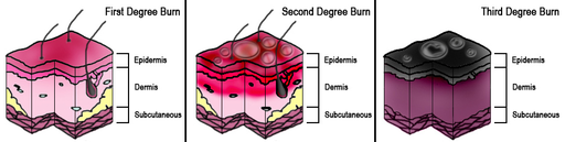 Burn Degree Diagram