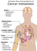 Symptoms of cancer metastasis depend location of the tumor