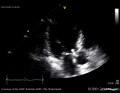 Soubor: Endokarditida aortální chlopně s vegetací E00119 (CardioNetworks ECHOpedia) .webm