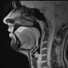 Soubor: MRI v reálném čase - polykání (ananasový džus) .ogv